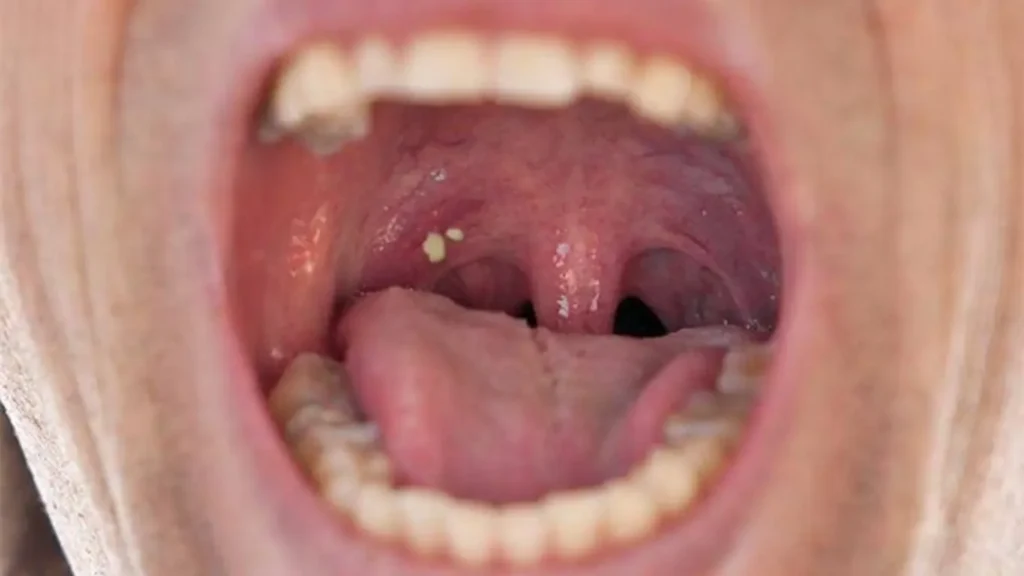 Can Tonsils Grow Back After Being Removed? - Tymoff