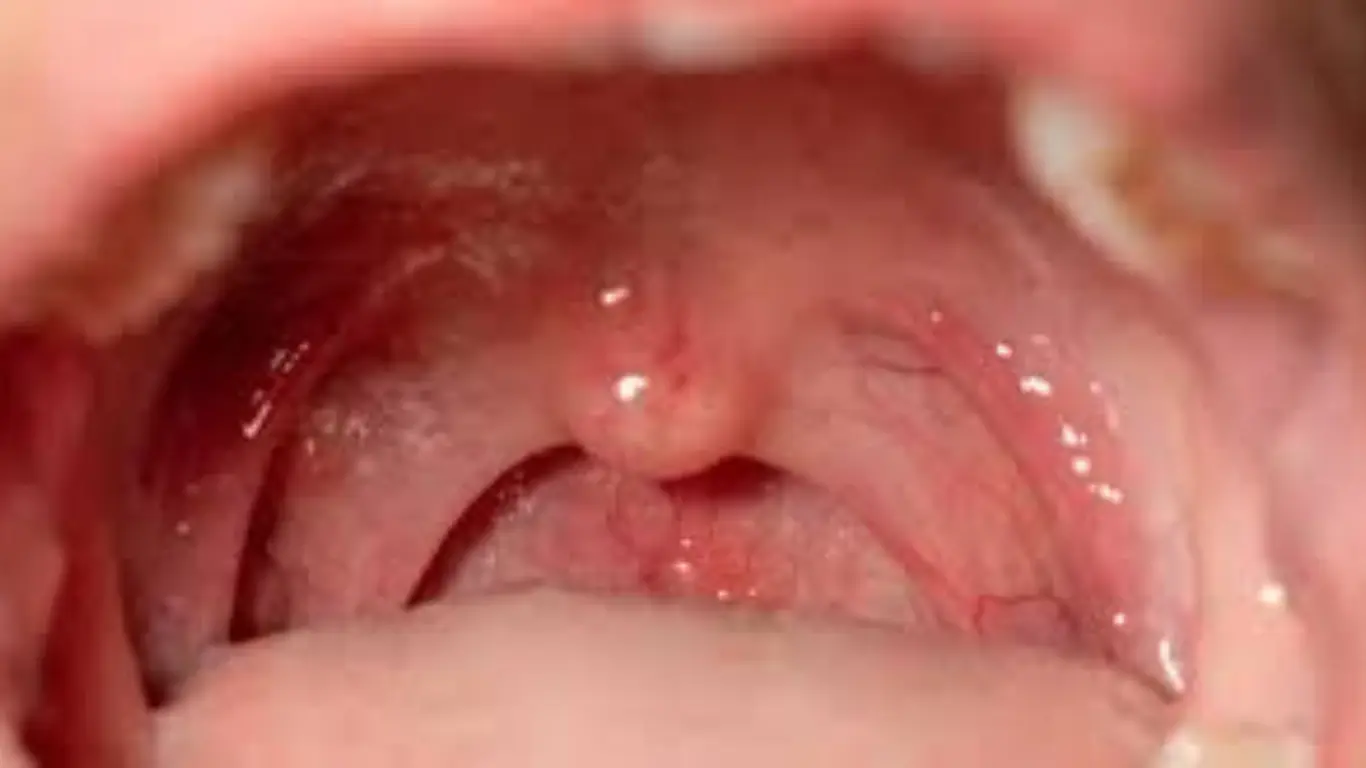 Can Tonsils Grow Back After Being Removed? - Tymoff